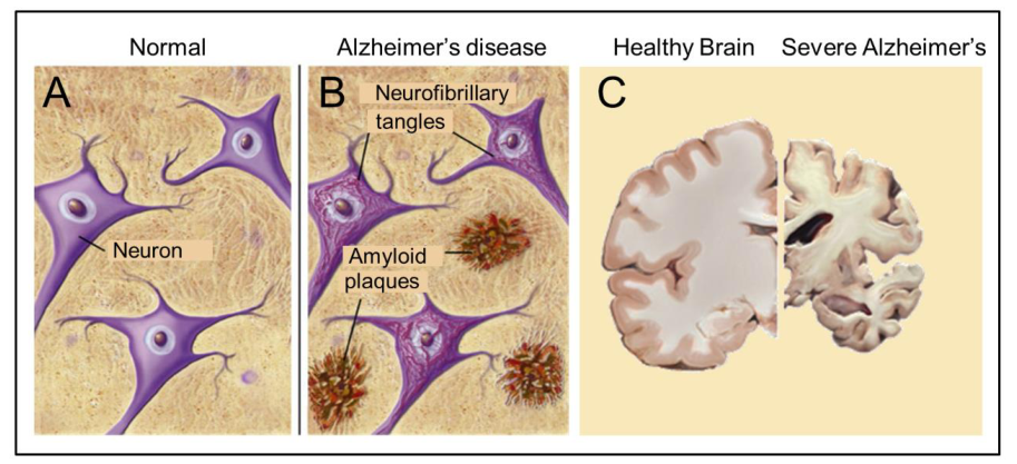 阿尔茨海默病的神经基础